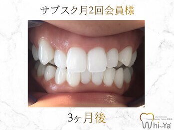 ホワイヤ セルフホワイトニング DBS神楽坂(Whi-Ya)/☆サブスク会員様☆納得の白さ☆