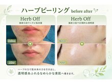 ポアラボ 佐久店(PORE LABO)/ハーブピーリング変化写真