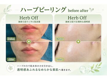 ポアラボ 佐久店(PORE LABO)/ハーブピーリング変化写真