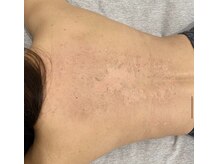 ビューティリュクス(beauty luxe)/お背中のDT有りハーブピーリング