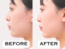 ビハリスト 恵比寿/二重顎のたるみを改善