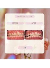 プラスビーセルフ(+b self)/ホワイトニングビフォーアフター