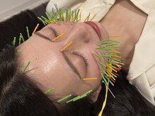 ソラナ(Solana)/美容鍼【100本】百華鍼