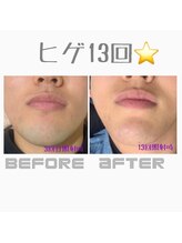 ジョアアンジェ 京橋店(joie ange)/青ひげ脱却