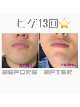 ジョアアンジェ 京橋店(joie ange)/青ひげ脱却