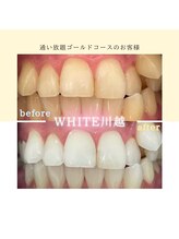 ホワイト 川越店(WHITE)/歯のbefore→after