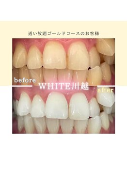 ホワイト 川越店(WHITE)/歯のbefore→after