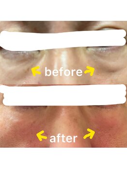 リビーナス(Re.venus)/目袋消し