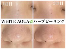 ホワイトアクア 天王寺本店(WHITE AQUA)/ハーブピーリングで毛穴ケア