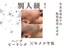 エステティック レイビス 銀座店(RAYVIS)/ハーブピーリング