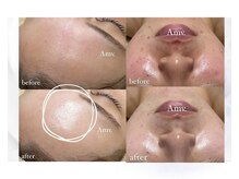 乾燥肌、敏感肌におすすめの施術★毛穴洗浄で汚れを落とす！