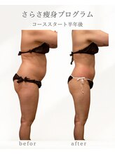 ナチュラル ビューティー スタイル さらさ(Natural Beauty Style)/脂肪冷却×血流循環ケア