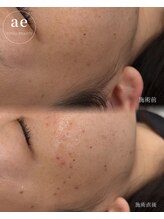 アエ(ae)/シミケア30分当て放題