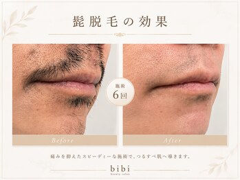 ビビ(bibi)/メンズヒゲ脱毛施術6回