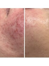 ティーティービューティー(TT Beauty)/エルモサハーブでこんなに変わる