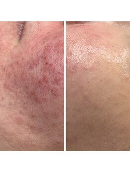 ティーティービューティー(TT Beauty)/エルモサハーブでこんなに変わる