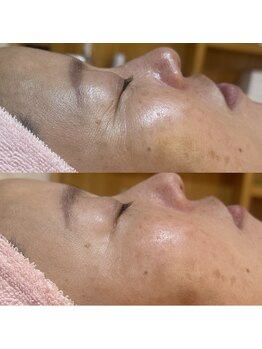 ポムポムボナー/ハリ/毛穴/小顔/美白同時改善♪