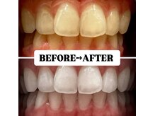 ホワイトニングサロン 豊中/Before&After美白ホワイトニング