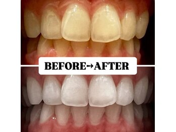 ホワイトニングサロン 豊中/Before&After美白ホワイトニング