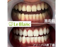 ルブラン 奈良店(Le Blanc)/【これからに向けて白い歯に！】