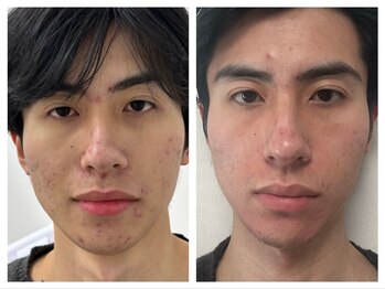 洗顔サロン 池袋(SENGAN)/ハーブピーリング