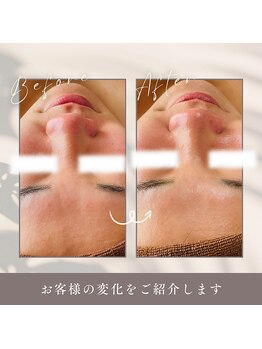 ルーク(Luke)/ビフォーアフター