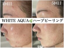 ホワイトアクア 錦糸町店(WHITE AQUA)/ハーブピーリング/東京/錦糸町