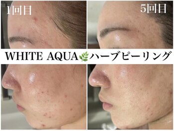 ホワイトアクア 錦糸町店(WHITE AQUA)/ハーブピーリング/東京/錦糸町