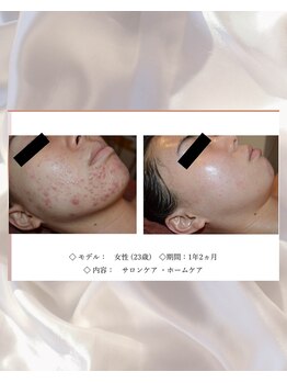 エテル(eter)/エクスビアンPHA水光ピール