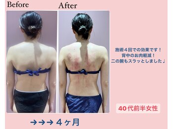 じぶんdeエステ 梅田店/CELLZERO.式 症例/4回/-6kg