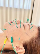 えにし整体 鍼灸整骨院/美容鍼灸の効果をさらにUP☆