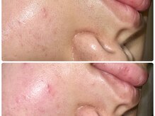 レネット サロン 立川店(Reinette Salon)/フェイスワックス