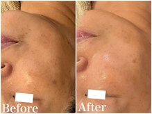 サロンドフェイス(Salon de Faith)/ハーブピーリング