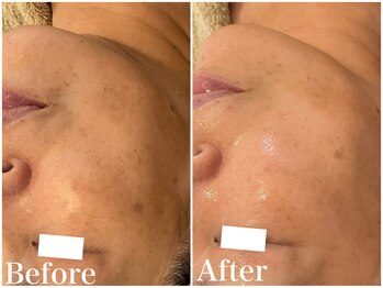 サロンドフェイス(Salon de Faith)/ハーブピーリング