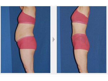 Nビューティー/最新エンダモロジーBODY