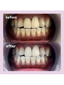 パレ 大阪十三店(Palet)/before/after