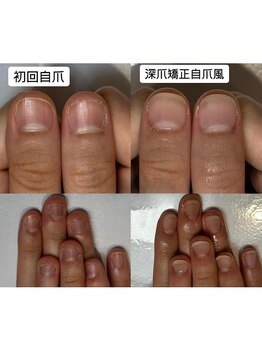 ティアラネイル 宇都宮/深爪矯正