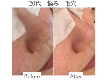 ファニービー 吹田店/20代 毛穴 1回の施術変化