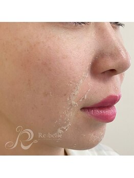 ベルメイク(BELLE MAKE)/リベルハーブピーリング☆剥離