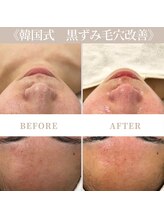 リアム(LiAm)/韓国式毛穴洗浄