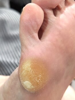 001 新横浜/タコやウオノメは一回で施術終了