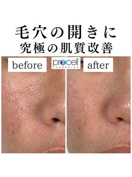 フェリス(FELIZ)/ダウンタイムなし