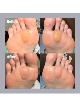 巻き爪補正店 天王寺店/タコ・魚の目・角質、まとめて!