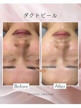 ソユ(SOYOU)/施術* &nbsp;&nbsp;&nbsp;ダクトピール