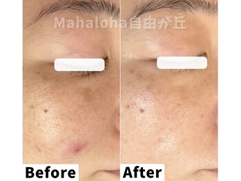 マハロハ 自由が丘(Mahaloha)/【毛穴つまり・黒ずみ改善施術】