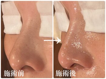 ビーフリー(Be free)/毛穴改善コース／吹田市/千里丘