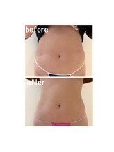 ラディアント(Radiant)/インディバ×レモンボトル