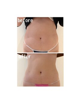 ラディアント(Radiant)/インディバ×レモンボトル