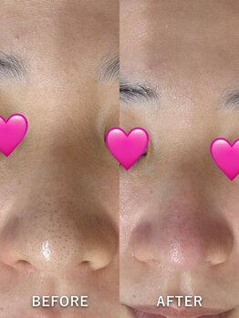 ベルミーランド MEGAドン・キホーテ草加/毛穴ケアBefore→After