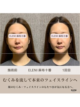 エレーニ 麻布十番(ELENI)/小顔が一回でここまで変わる。
